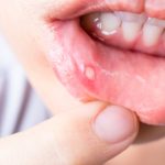 a woman holds down her lower lip showing a mouth ulcer