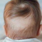 baby losing hair in the back of head