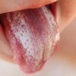 candidiasis oral