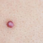 close up of a skin tag on a womans skin